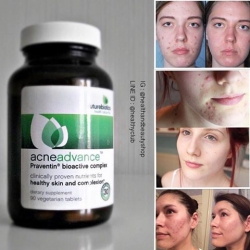 # เรื่องสิวเรื่องเล็ก # FutureBiotics, AcneAdvance with Colostrum, 90 Vegetarian Tablets